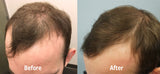 JYTOP LLLT Laser Hair Regrowth Helmet Hair Loss therapy androgenetic aalopecia treatment KN8000C